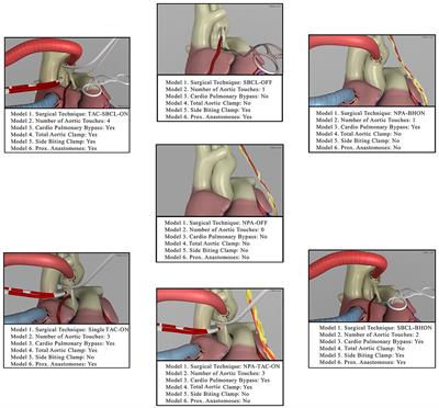 Surgical Risk Factors for Ischemic Stroke Following Coronary Artery Bypass Grafting. A Multi-Factor Multimodel Analysis